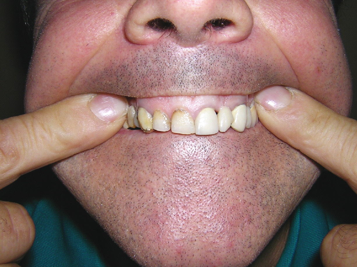 Nhiễm độc chì - Hình ảnh minh họa